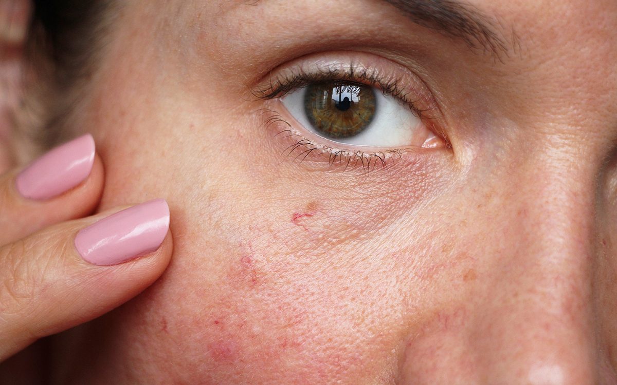Are Facial Aesthetic Treatments Suitable for People with Sensitive Skin?