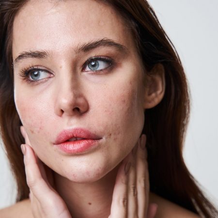 Effective Treatments for Acne