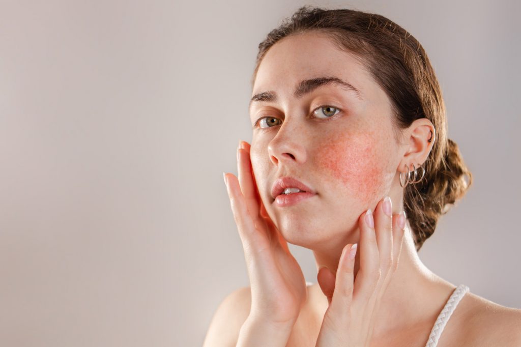 How to Treat Rosacea