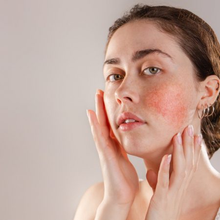 How to Treat Rosacea