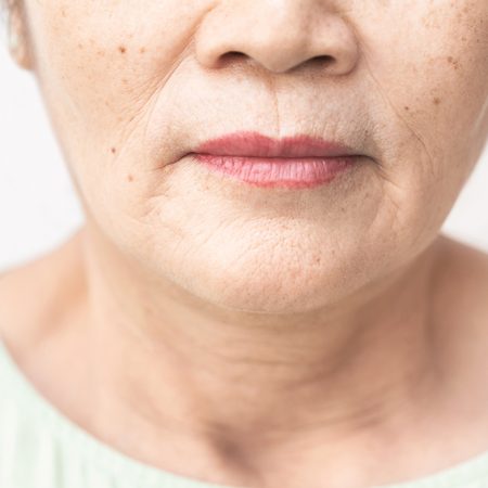 How to Get Rid of Lines Around the Mouth