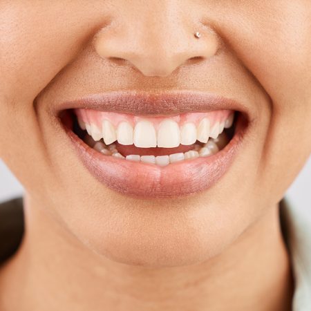 How to Get Rid of a Gummy Smile